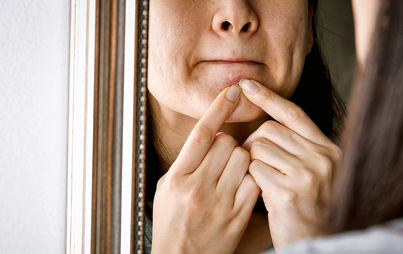 cinco erros no tratamento da acne que voce deve evitar