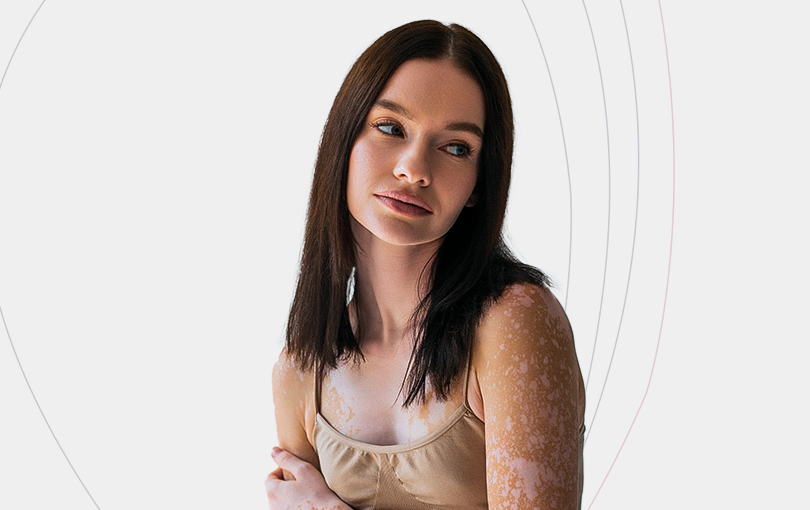 Vitiligo: desvende as causas e os melhores tratamentos para essa condição